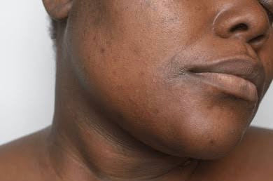 Simple 5-step routine to clear hyperpigmentation on your face